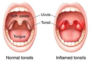 Tonsil reddness are common symptoms of tonsil stones